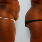 Liposuction before and after photos in Houston, TX, Patient 28958