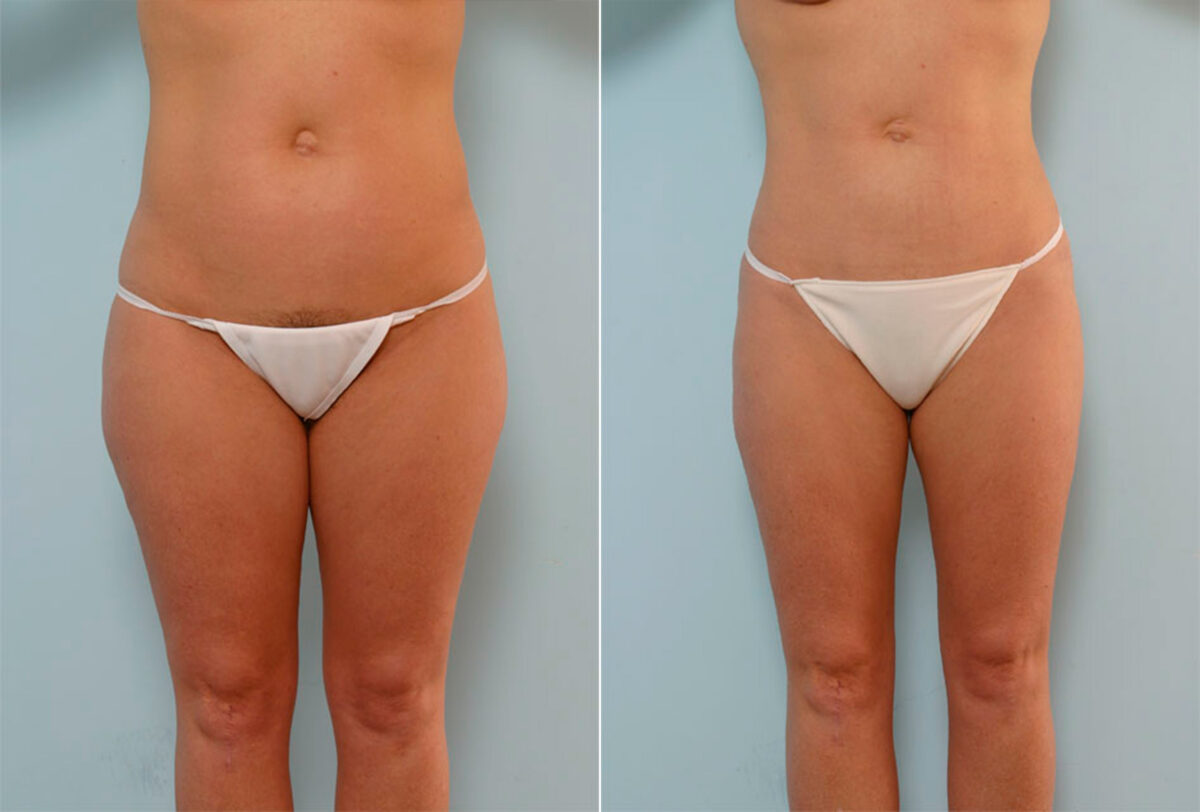 Liposuction before and after photos in Houston, TX, Patient 28965
