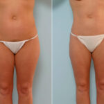 Liposuction before and after photos in Houston, TX, Patient 28965