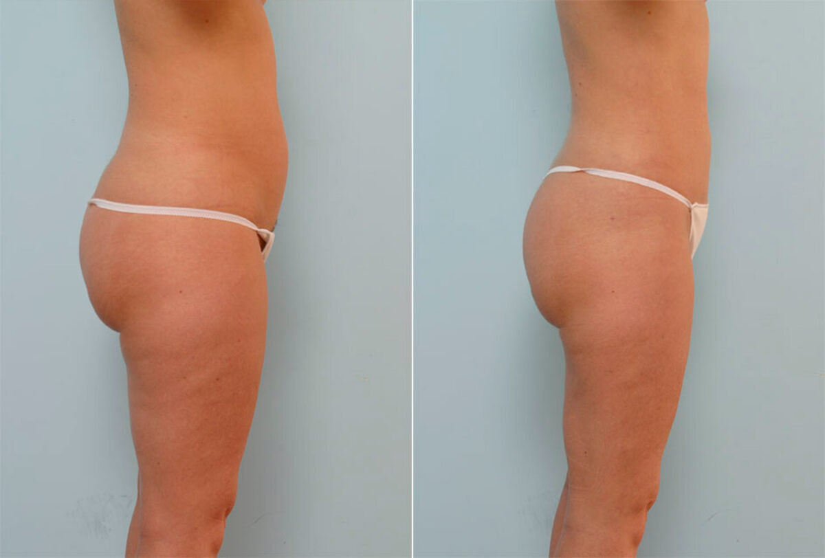 Liposuction before and after photos in Houston, TX, Patient 28965