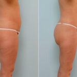 Liposuction before and after photos in Houston, TX, Patient 28965