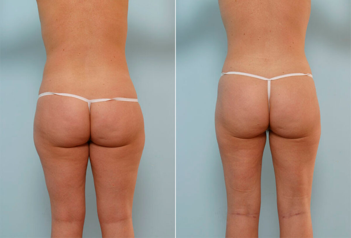 Liposuction before and after photos in Houston, TX, Patient 28965