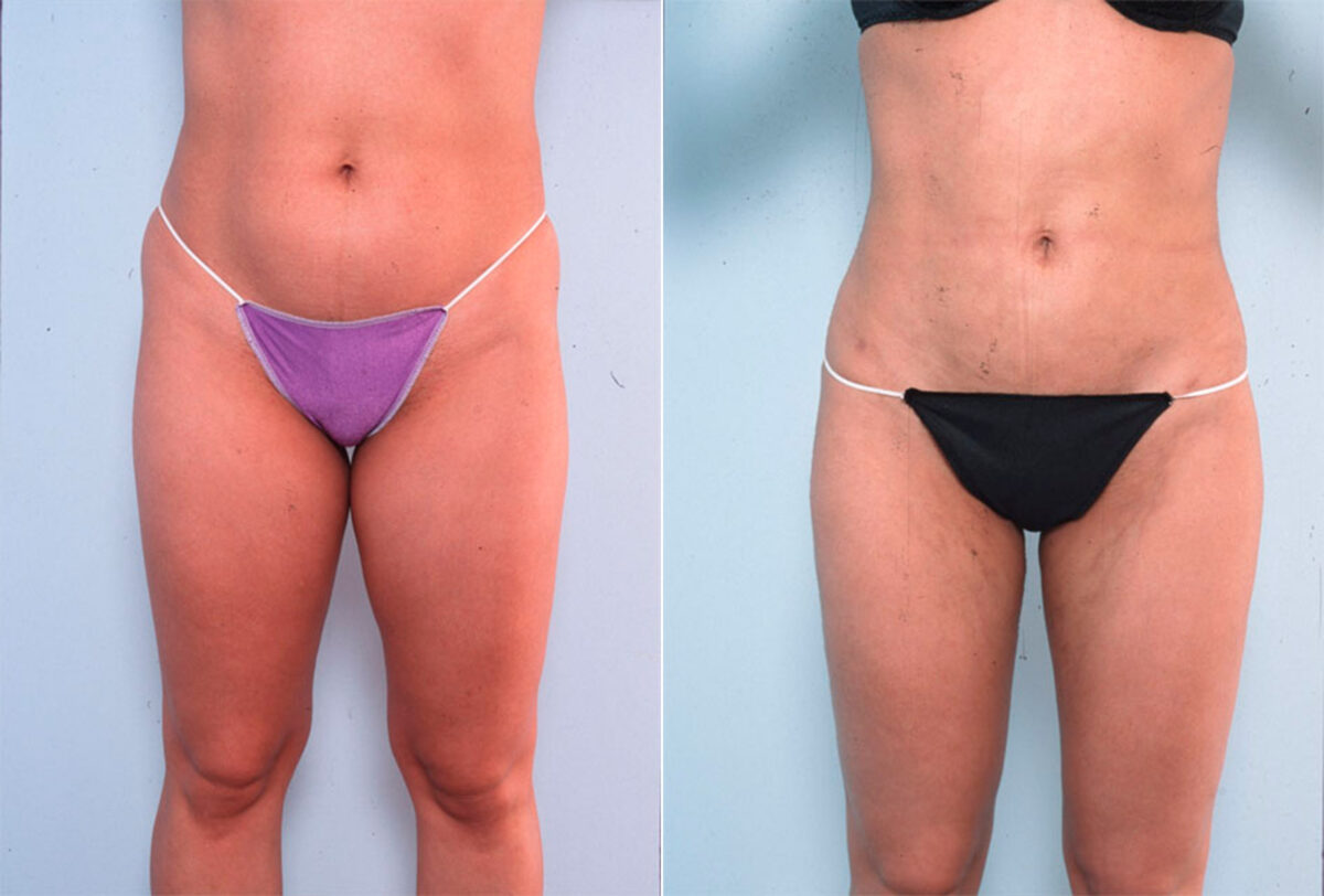 Liposuction before and after photos in Houston, TX, Patient 28972