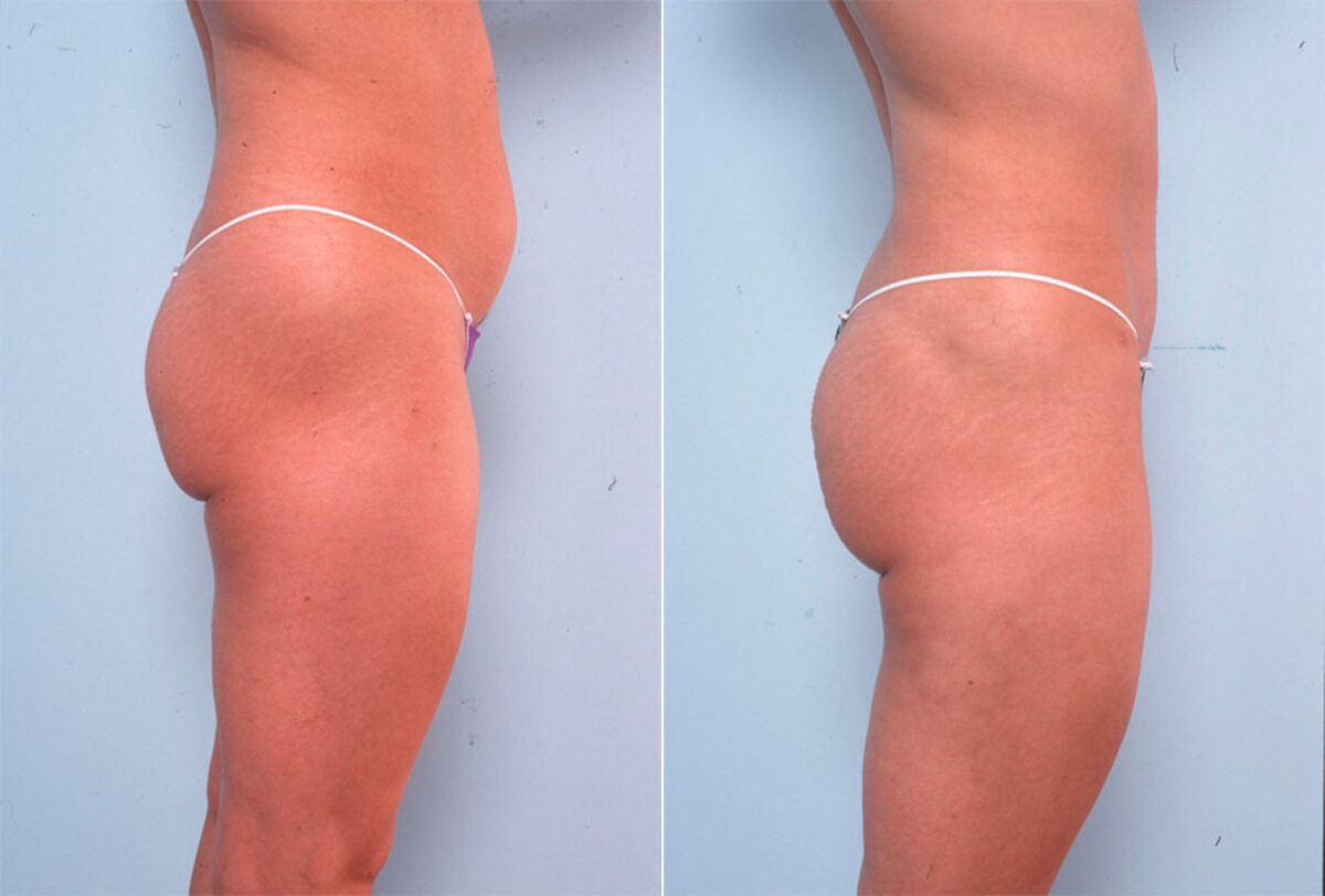 Liposuction before and after photos in Houston, TX, Patient 28972