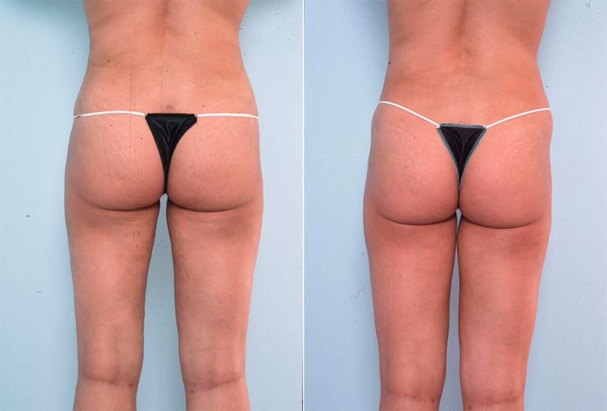 Liposuction before and after photos in Houston, TX, Patient 28972