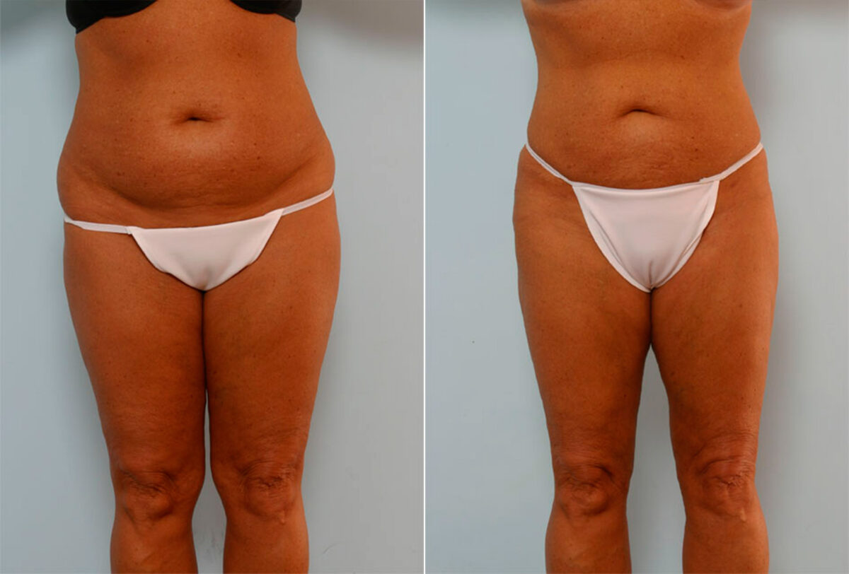 Liposuction Before and After Photos