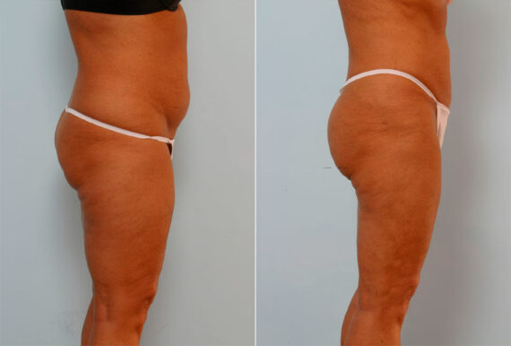 Liposuction before and after photos in Houston, TX, Patient 28979