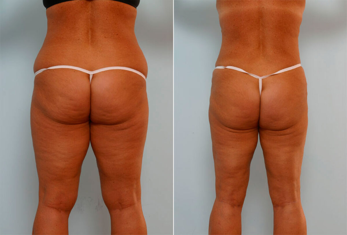 Liposuction before and after photos in Houston, TX, Patient 28979