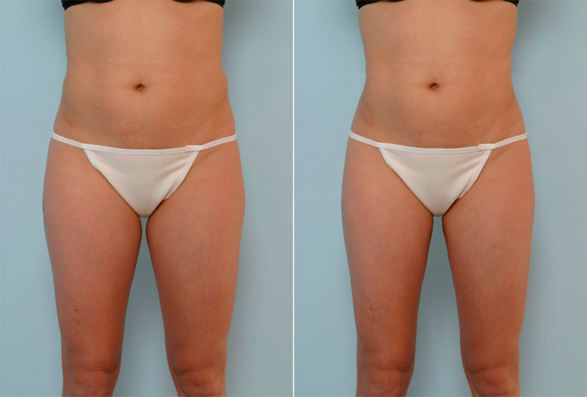 Liposuction before and after photos in Houston, TX, Patient 28986