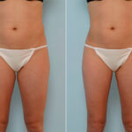 Liposuction before and after photos in Houston, TX, Patient 28986