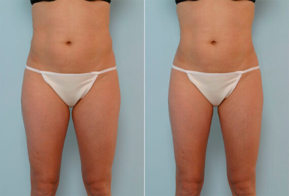 Liposuction before and after photos in Houston, TX, Patient 28986