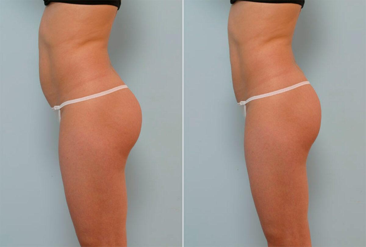 Liposuction before and after photos in Houston, TX, Patient 28986