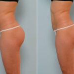 Liposuction before and after photos in Houston, TX, Patient 28986