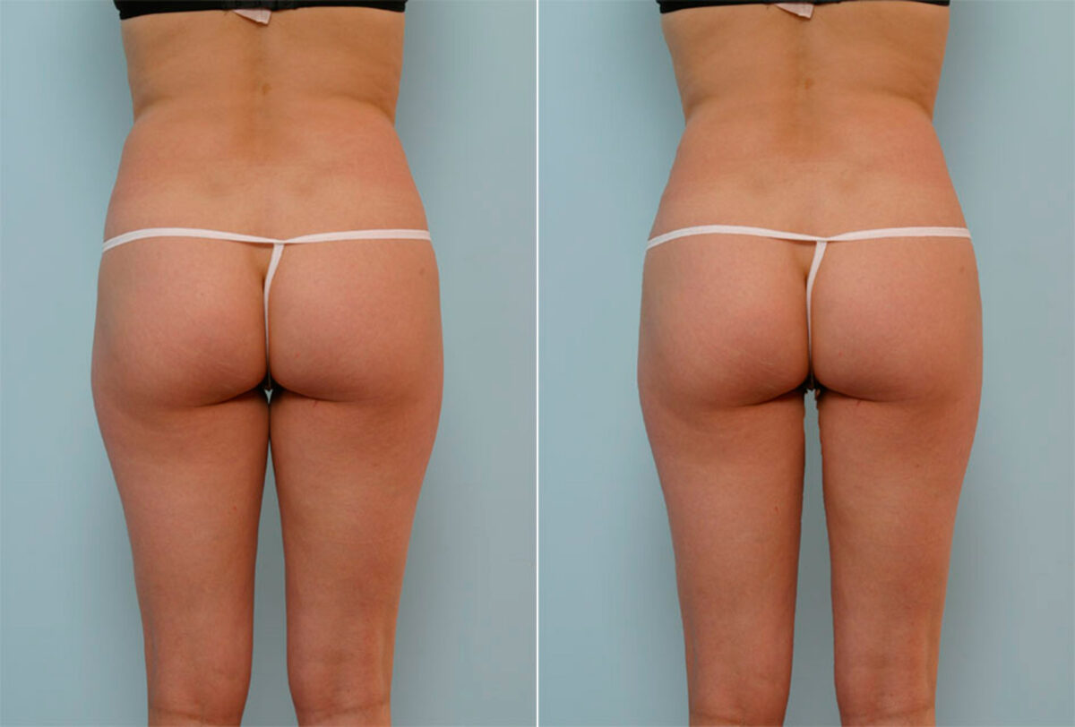 Liposuction before and after photos in Houston, TX, Patient 28986