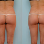 Liposuction before and after photos in Houston, TX, Patient 28986