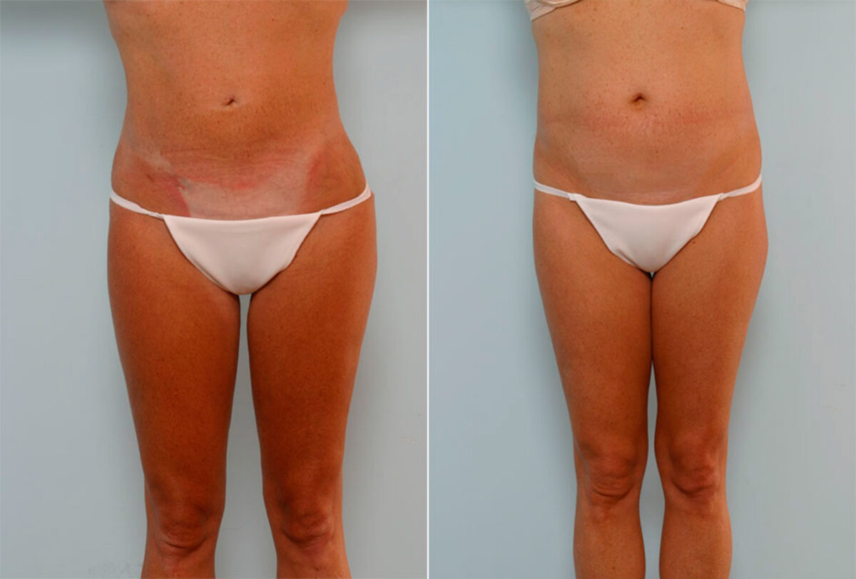 Liposuction before and after photos in Houston, TX, Patient 28993