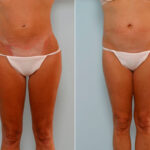 Liposuction before and after photos in Houston, TX, Patient 28993