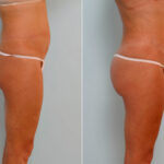 Liposuction before and after photos in Houston, TX, Patient 28993