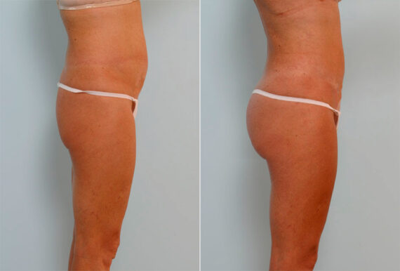 Liposuction before and after photos in Houston, TX, Patient 28993