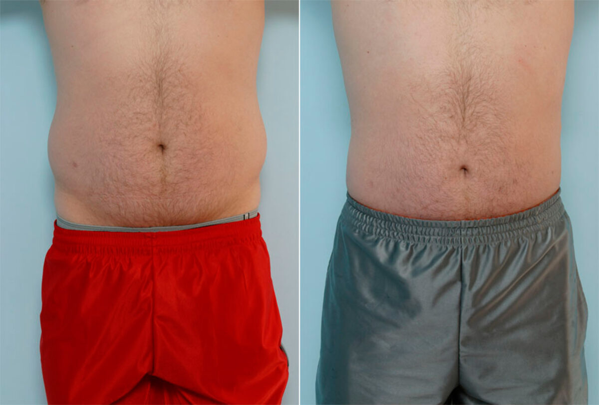 Liposuction before and after photos in Houston, TX, Patient 28998