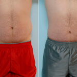 Liposuction before and after photos in Houston, TX, Patient 28998