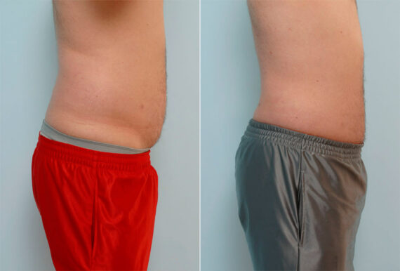 Liposuction before and after photos in Houston, TX, Patient 28998