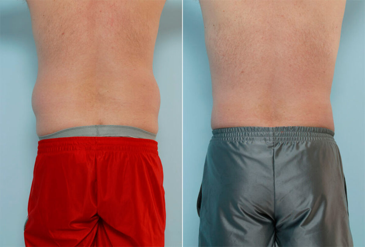 Liposuction before and after photos in Houston, TX, Patient 28998