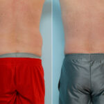Liposuction before and after photos in Houston, TX, Patient 28998