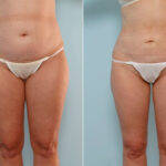 Liposuction before and after photos in Houston, TX, Patient 29005