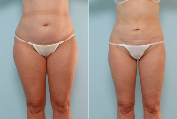 Liposuction before and after photos in Houston, TX, Patient 29005