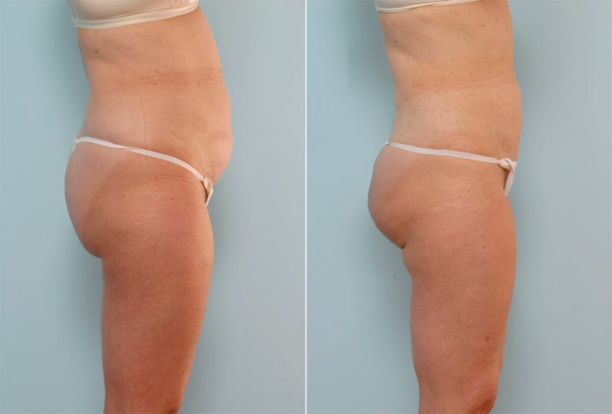 Liposuction before and after photos in Houston, TX, Patient 29005