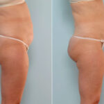 Liposuction before and after photos in Houston, TX, Patient 29005