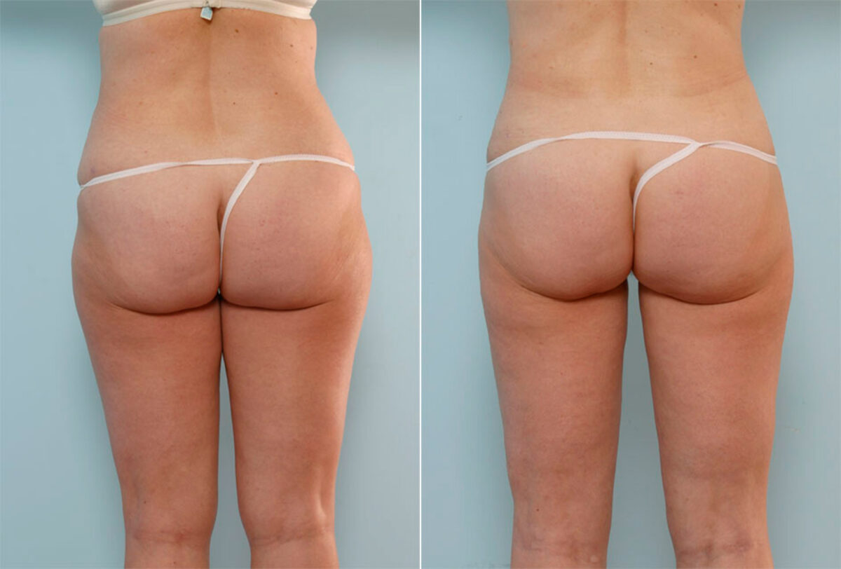 Liposuction before and after photos in Houston, TX, Patient 29005