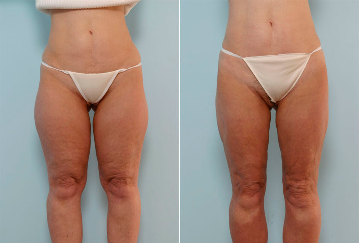 Liposuction before and after photos in Houston, TX, Patient 29012
