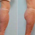 Liposuction before and after photos in Houston, TX, Patient 29012