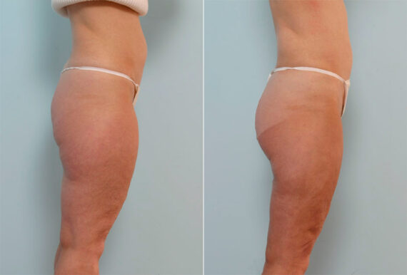 Liposuction before and after photos in Houston, TX, Patient 29012