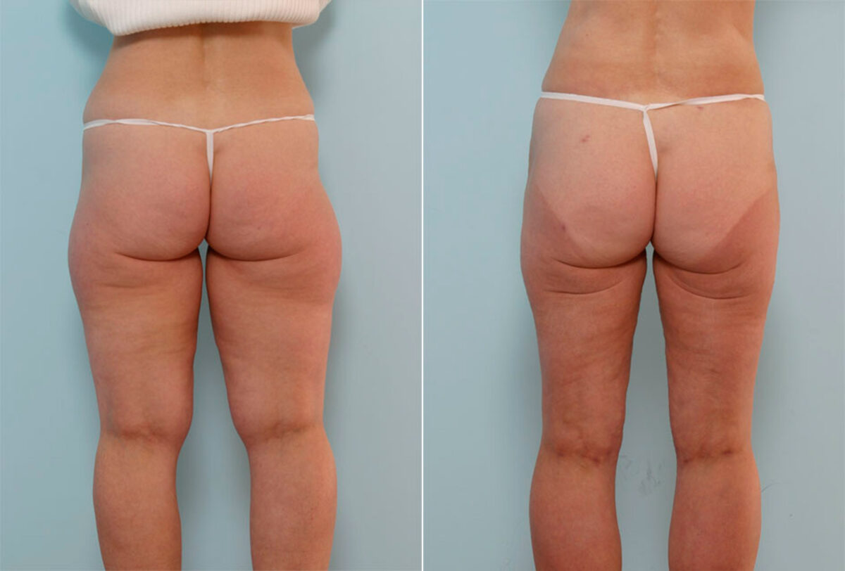 Liposuction before and after photos in Houston, TX, Patient 29012