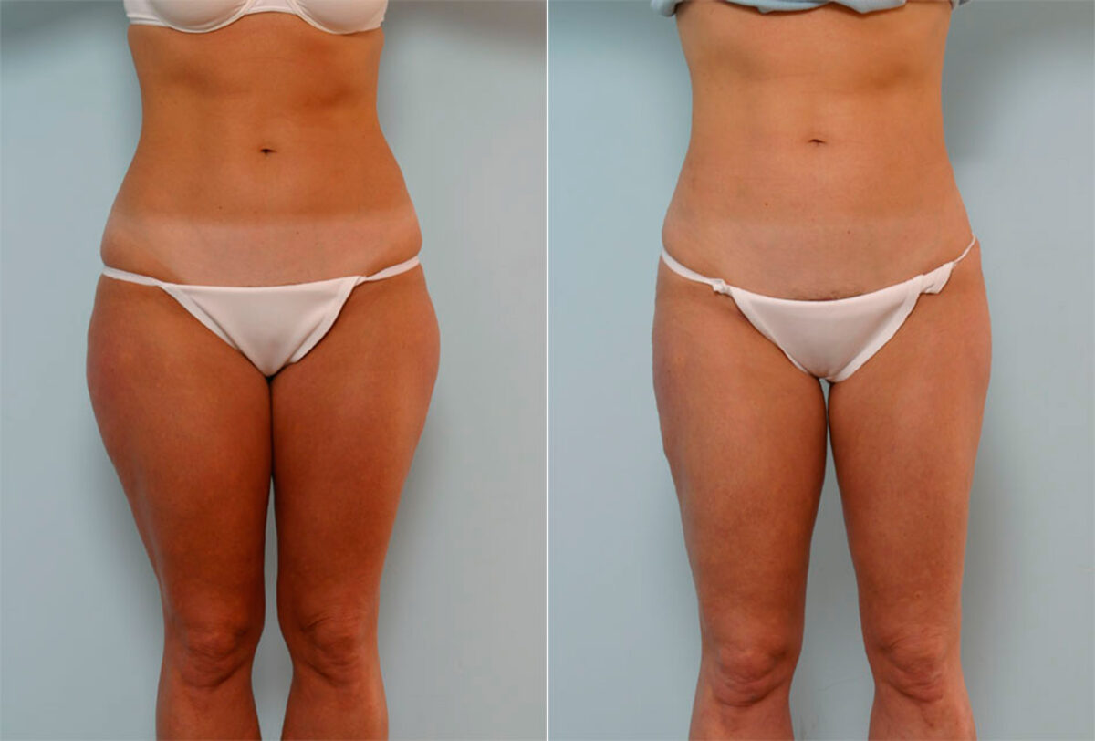 Liposuction before and after photos in Houston, TX, Patient 29019