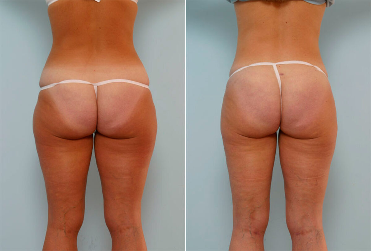 Liposuction before and after photos in Houston, TX, Patient 29019