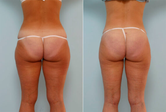 Liposuction before and after photos in Houston, TX, Patient 29019