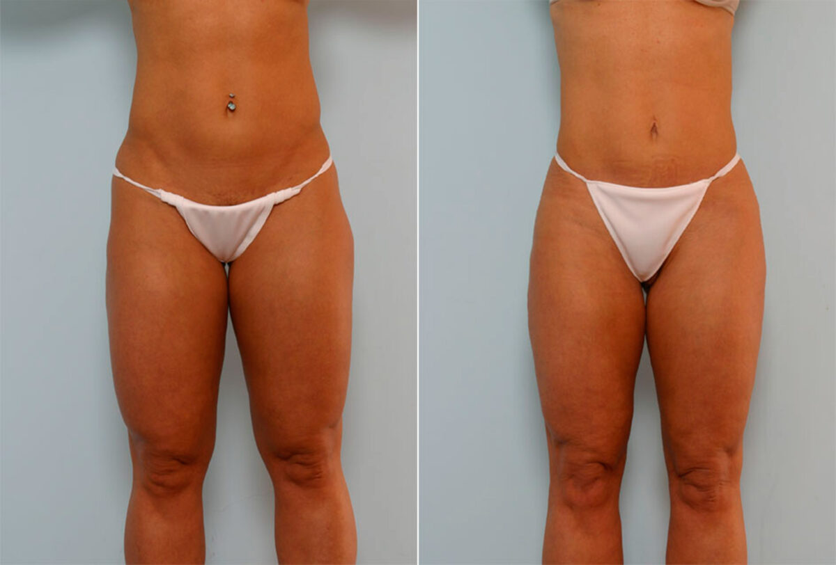 Liposuction before and after photos in Houston, TX, Patient 29024