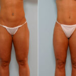 Liposuction before and after photos in Houston, TX, Patient 29024