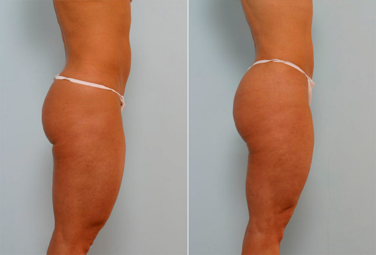 Liposuction before and after photos in Houston, TX, Patient 29024