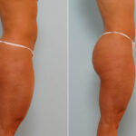 Liposuction before and after photos in Houston, TX, Patient 29024