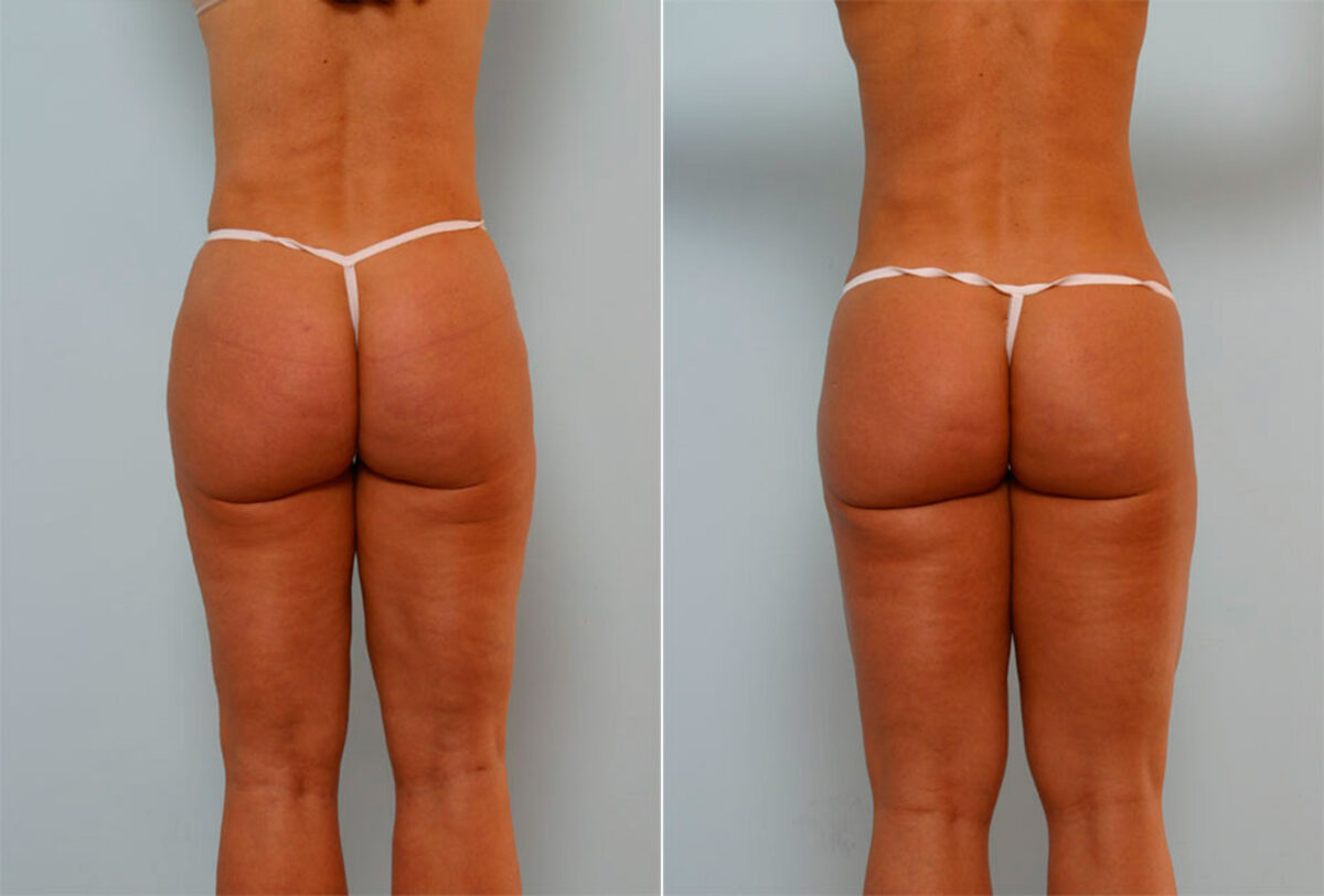 Liposuction before and after photos in Houston, TX, Patient 29024