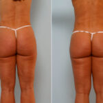 Liposuction before and after photos in Houston, TX, Patient 29024