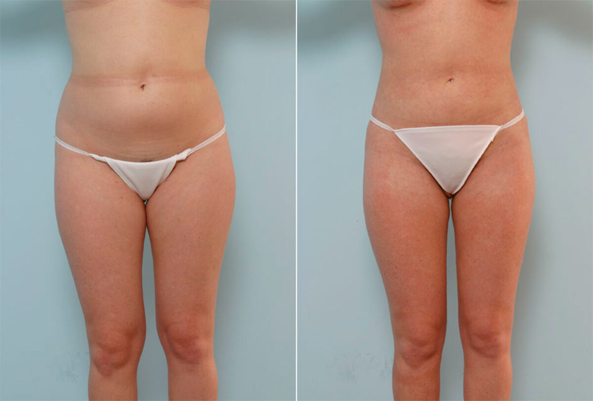 Liposuction before and after photos in Houston, TX, Patient 29031