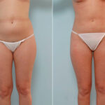 Liposuction before and after photos in Houston, TX, Patient 29031