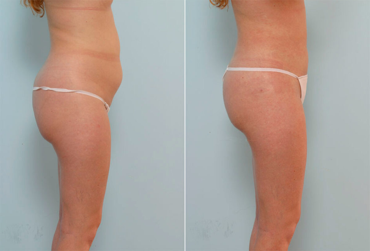 Liposuction before and after photos in Houston, TX, Patient 29031