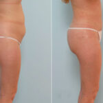 Liposuction before and after photos in Houston, TX, Patient 29031